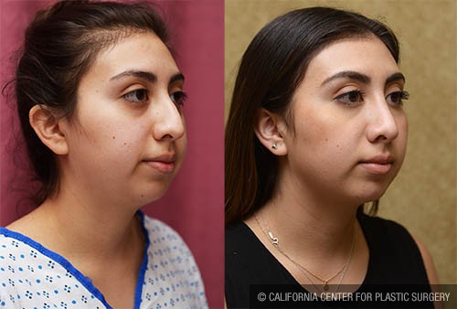 Rhinoplasty - Middle Eastern Before & After Patient #12825