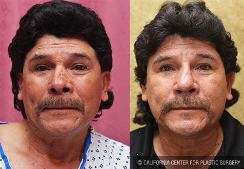 Hispanic Rhinoplasty Before & After Patient #12914