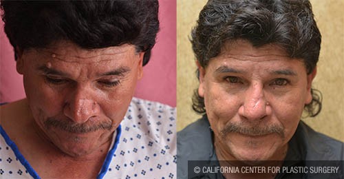 Rhinoplasty - Hispanic Before & After Patient #12817