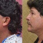 Rhinoplasty - Hispanic Before & After Patient #12817