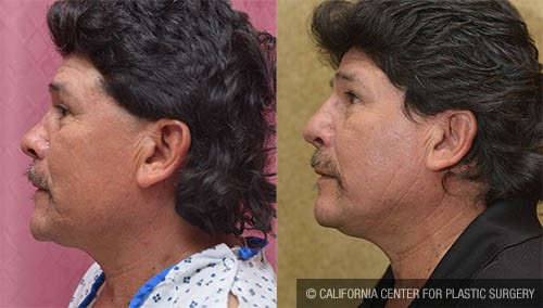 Rhinoplasty - Hispanic Before & After Patient #12817