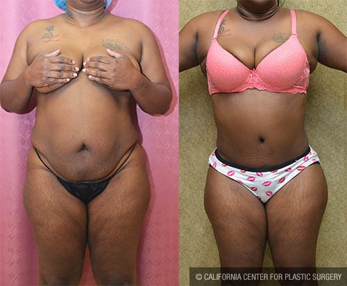 Tummy Tuck (Abdominoplasty) Plus Size Before & After Patient #12831