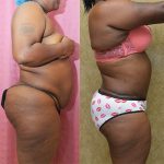 Tummy Tuck (Abdominoplasty) Plus Size Before & After Patient #12831