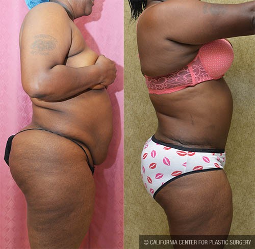 Tummy Tuck (Abdominoplasty) Plus Size Before & After Patient #12831