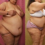 Tummy Tuck (Abdominoplasty) Super Plus Size Before & After Patient #12875