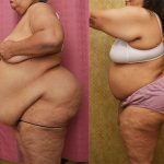 Tummy Tuck (Abdominoplasty) Super Plus Size Before & After Patient #12875