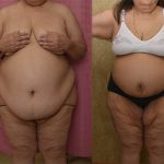 Tummy Tuck (Abdominoplasty) Super Plus Size Before & After Patient #12875