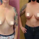 Breast Lift (Mastopexy) Before & After Patient #13028