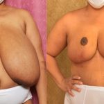 Breast Reduction Before & After Patient #13032