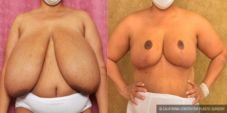 Breast Reduction Before & After Patient #13032