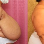 Breast Reduction Before & After Patient #13032