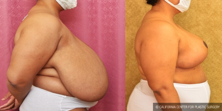 Breast Reduction Before & After Patient #13032