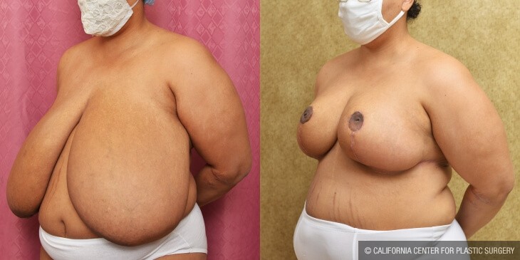 Breast Reduction Before & After Patient #13032