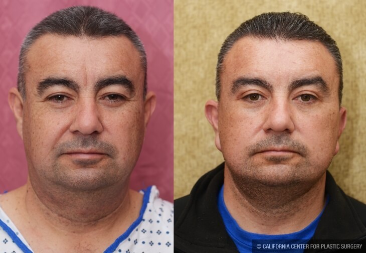 Male Neck & Face Liposuction Before & After Patient #13040