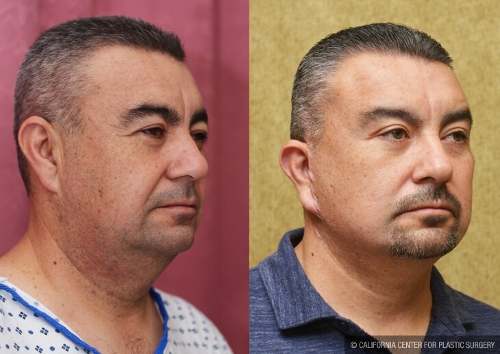 Male Neck & Face Liposuction Before & After Patient #13040