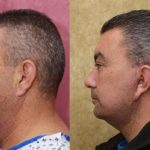 Male Neck & Face Liposuction Before & After Patient #13040