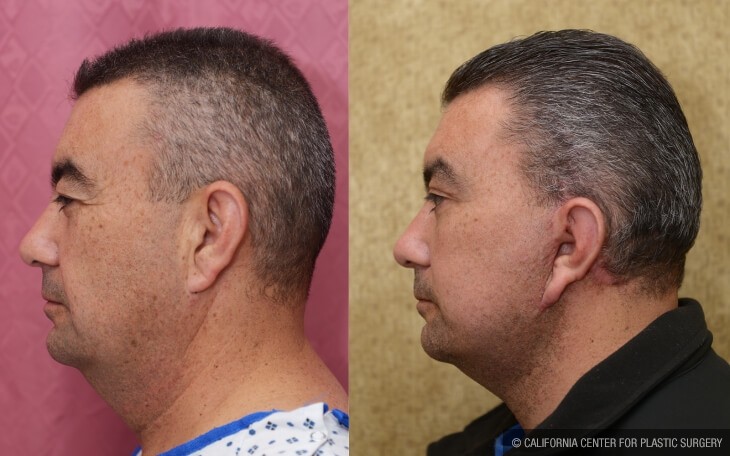 Male Neck & Face Liposuction Before & After Patient #13040