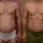 Liposuction Abdomen Medium Before & After Patient #13023