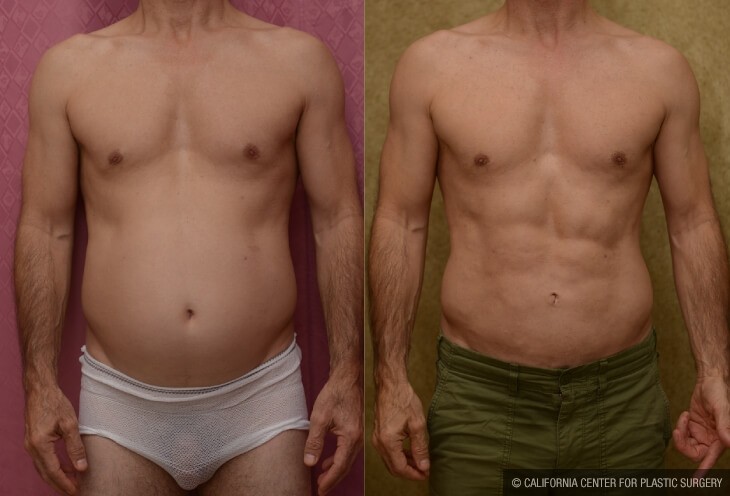 Liposuction Abdomen Medium Before & After Patient #13023
