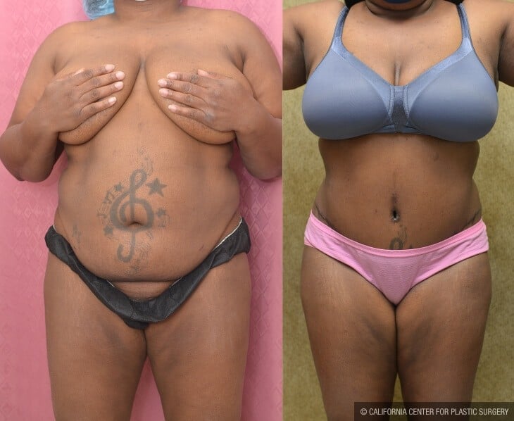 Tummy Tuck (Abdominoplasty) Plus Size Before & After Patient #13063