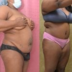 Tummy Tuck (Abdominoplasty) Plus Size Before & After Patient #13063