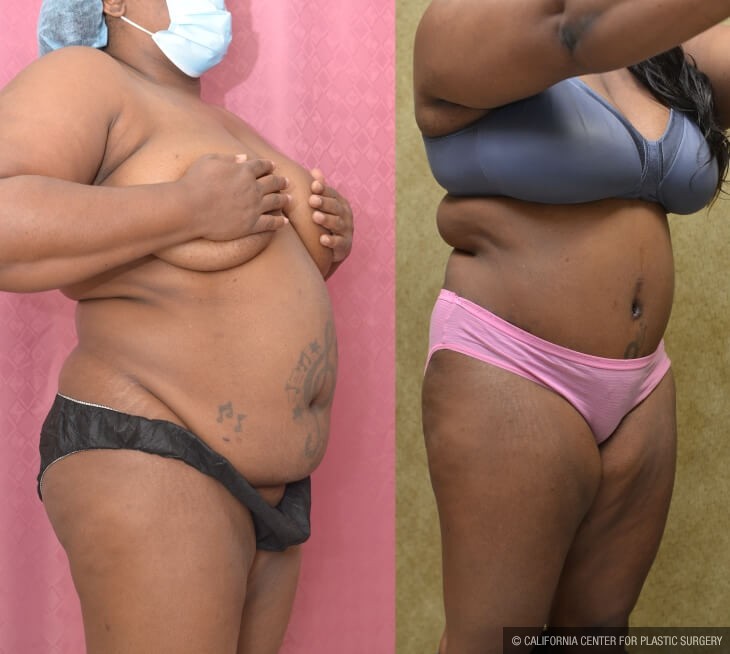 Tummy Tuck (Abdominoplasty) Plus Size Before & After Patient #13063