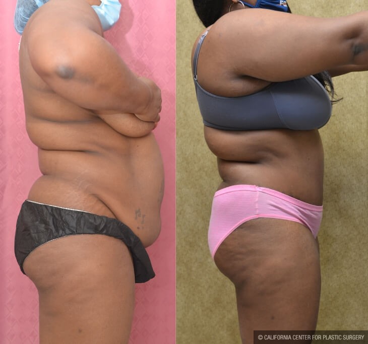 Tummy Tuck (Abdominoplasty) Plus Size Before & After Patient #13063