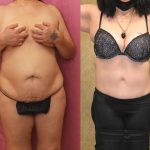Tummy Tuck (Abdominoplasty) Medium Size Before & After Patient #13075