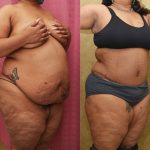 Tummy Tuck (Abdominoplasty) Plus Size Before & After Patient #13079