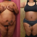 Tummy Tuck (Abdominoplasty) Plus Size Before & After Patient #13079