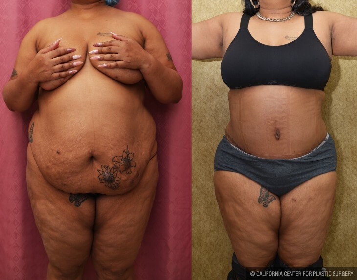 Tummy Tuck (Abdominoplasty) Plus Size Before & After Patient #13079
