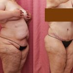 Tummy Tuck (Abdominoplasty) Plus Size Before & After Patient #13083