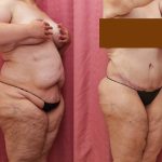 Tummy Tuck (Abdominoplasty) Plus Size Before & After Patient #13119