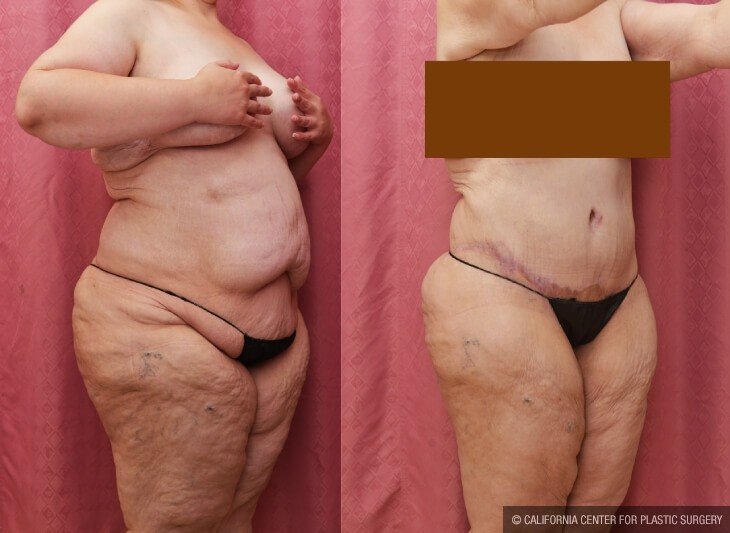 Tummy Tuck (Abdominoplasty) Plus Size Before & After Patient #13083