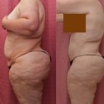 Tummy Tuck (Abdominoplasty) Plus Size Before & After Patient #13083