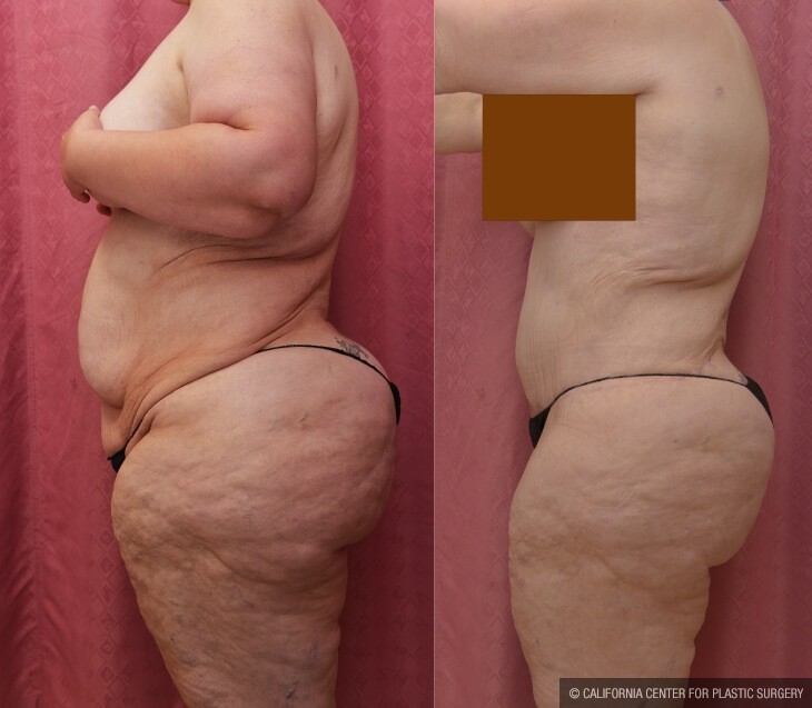 Tummy Tuck (Abdominoplasty) Plus Size Before & After Patient #13083