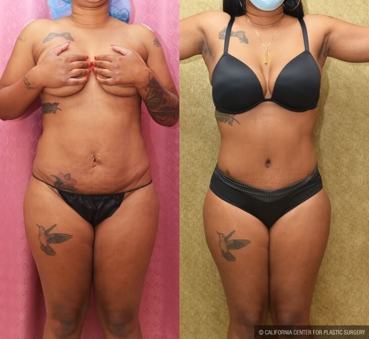 Tummy Tuck (Abdominoplasty) Small Size Before & After Patient #13088