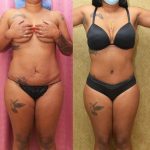 Tummy Tuck (Abdominoplasty) Medium Size Before & After Patient #13062