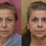 Eyelid (Blepharoplasty) Before & After Patient #13036