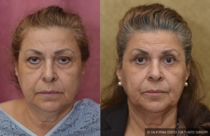 Eyelid (Blepharoplasty) Before & After Patient #13036