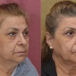 Eyelid (Blepharoplasty) Before & After Patient #13036