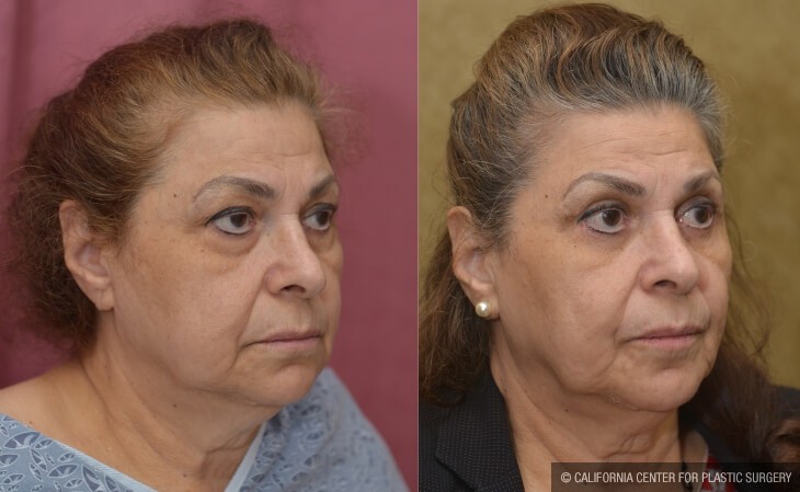 Eyelid (Blepharoplasty) Before & After Patient #13036