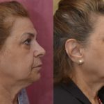 Eyelid (Blepharoplasty) Before & After Patient #13036
