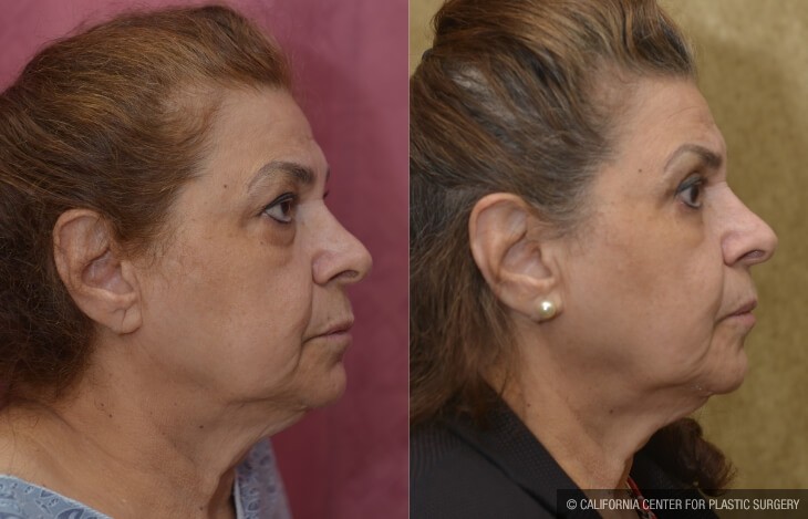 Eyelid (Blepharoplasty) Before & After Patient #13036