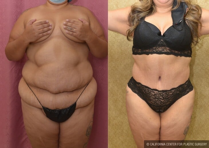 Tummy Tuck (Abdominoplasty) Plus Size Before & After Patient #13046