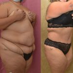 Tummy Tuck (Abdominoplasty) Plus Size Before & After Patient #13046