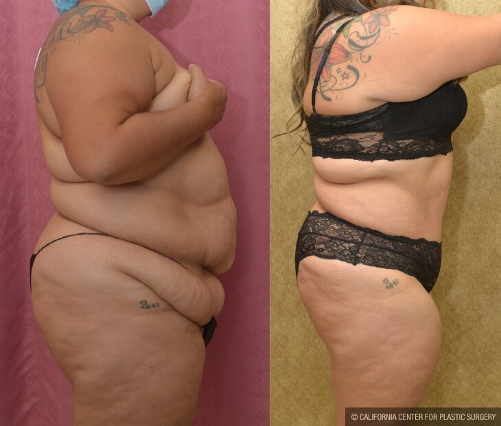 Tummy Tuck (Abdominoplasty) Plus Size Before & After Patient #13046