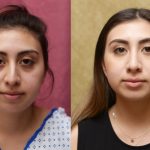 Rhinoplasty - Middle Eastern Before & After Patient #13055