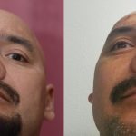 Rhinoplasty - Hispanic Before & After Patient #13048