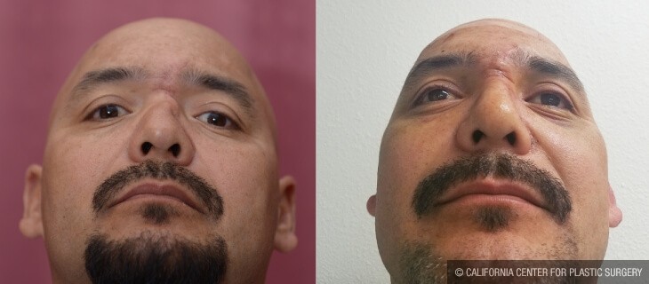 Rhinoplasty - Hispanic Before & After Patient #13048